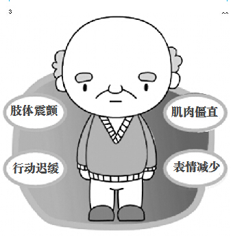 帕金森病发作的原因